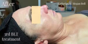 After Image: BLT Facial