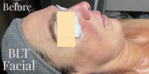 Before Image: BLT Facial