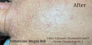 After Image: Back Facials