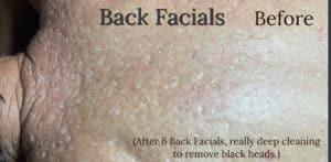 Before Image: Back Facials