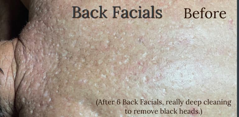 Before Image: Back Facials - front
