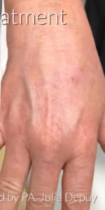 After Image: IPL Treatment