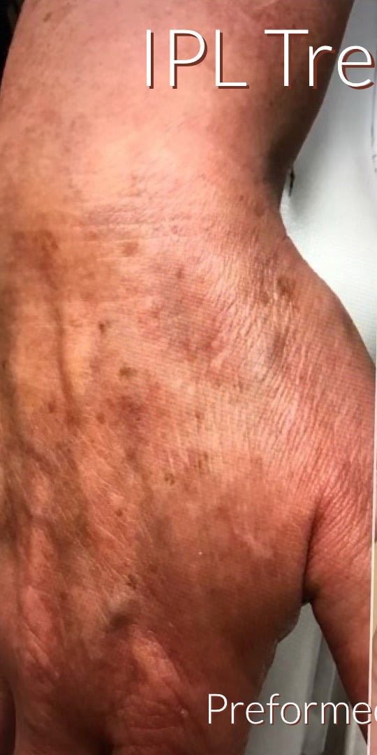 Before Image: IPL Treatment - front