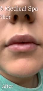After Image: Lip Filler
