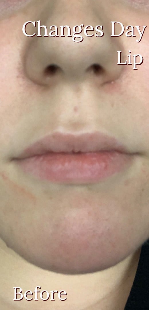 Before Image: Lip Filler - front