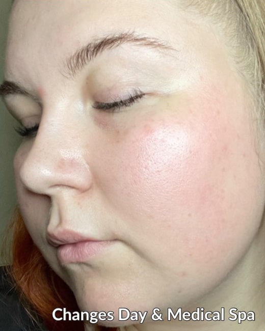 After Image: IPL - left-front-oblique