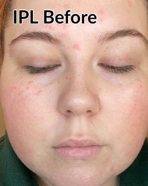 Before Image: IPL - front