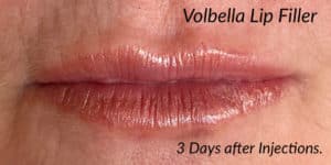 After Image: Volbella Lip Filler