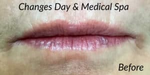 Before Image: Volbella Lip Filler
