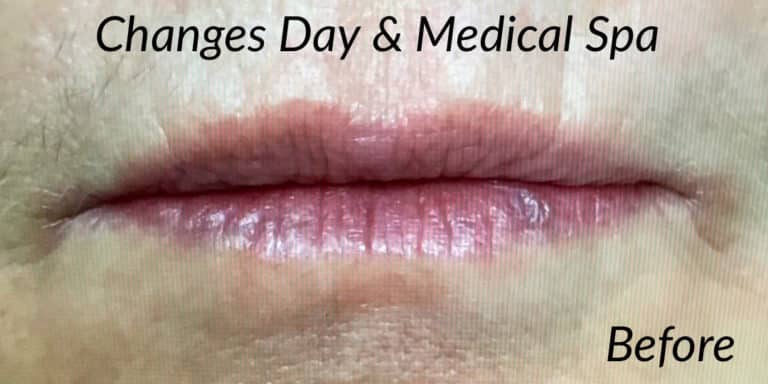 Before Image: Volbella Lip Filler - front