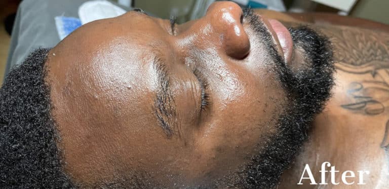 After Image: Signature Facial - front