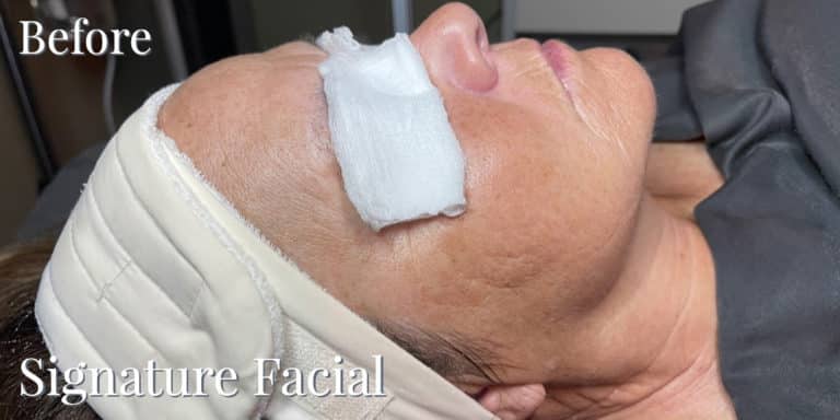 Before Image: Signature Facial - front