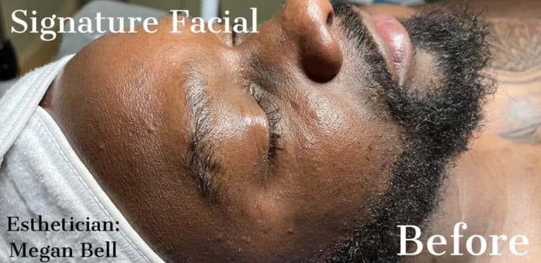 Before Image: Signature Facial - front